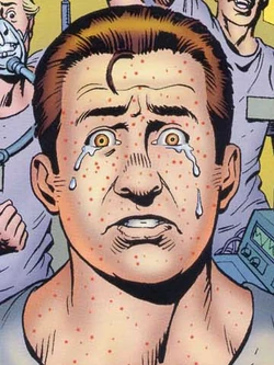 Measles