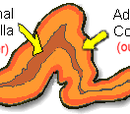 Cushing's disease