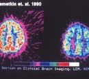 Attention Deficit/Hyperactivity Disorder
