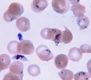 Malaria