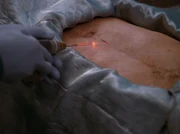 A laser scalpel in use in 2367